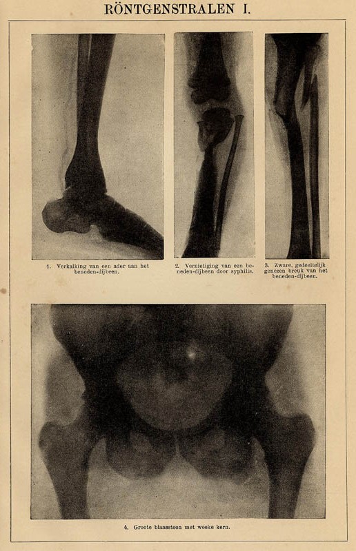 print Röntgenstralen I by Winkler Prins